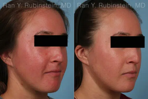 Laser Treatments Before and After Photos in Montvale, NJ, Patient 32259