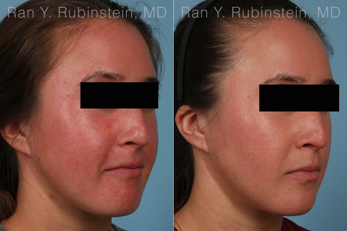 Laser Treatments Before and After Photos in Montvale, NJ, Patient 32259
