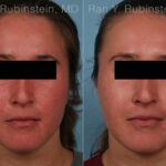 Laser Treatments Before and After Photos in Montvale, NJ, Patient 32259
