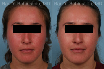 Laser Treatments Before and After Photos in Montvale, NJ, Patient 32259