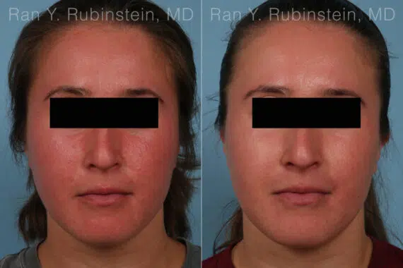 Laser Treatments Before and After Photos in Montvale, NJ, Patient 32259