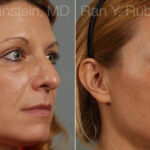 Eyelid Surgery Before and After Photos in Montvale, NJ, Patient 12591