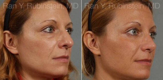 Eyelid Surgery Before and After Photos in Montvale, NJ, Patient 12591