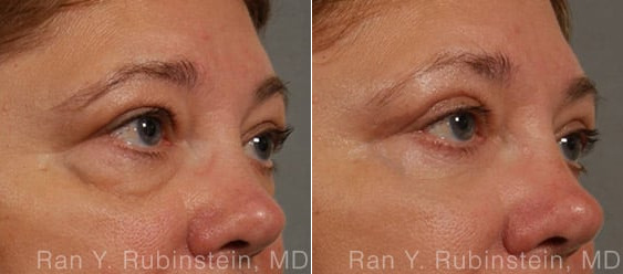 Eyelid Surgery Before and After Photos in Montvale, NJ, Patient 12596