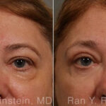 Eyelid Surgery Before and After Photos in Montvale, NJ, Patient 12596