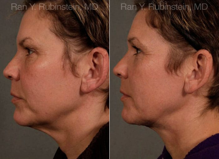 Face lift & Neck lift Before and After Photos in Montvale, NJ, Patient 12681