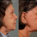 Sculptra Face Before and After Photos in Montvale, NJ, Patient 12791