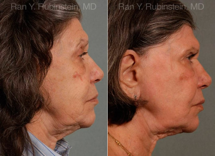 Sculptra Face Before and After Photos in Montvale, NJ, Patient 12791