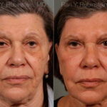 Sculptra Face Before and After Photos in Montvale, NJ, Patient 12791