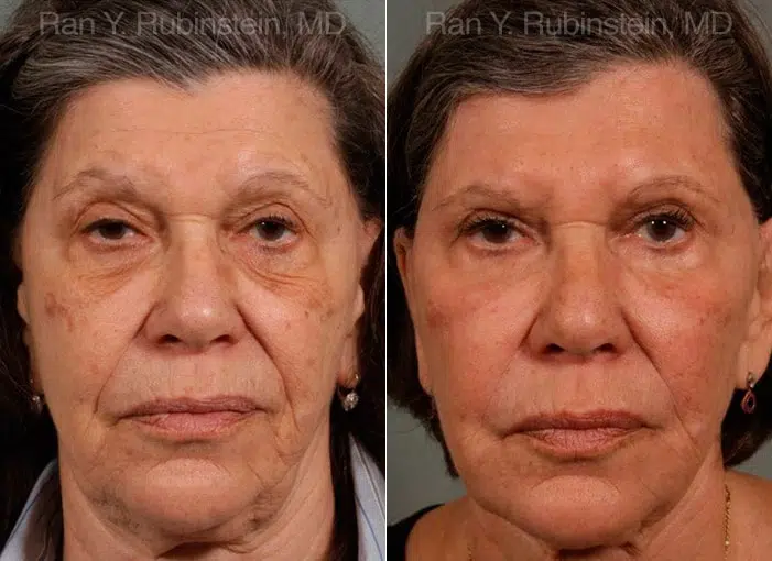 Sculptra Face Before and After Photos in Montvale, NJ, Patient 12791
