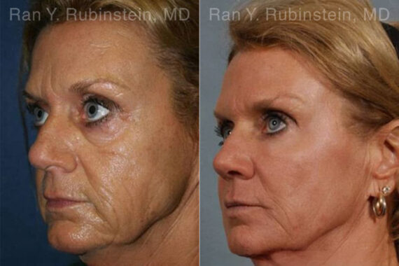 Laser Treatments Before and After Photos in Montvale, NJ, Patient 12820