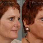Laser Treatments Before and After Photos in Montvale, NJ, Patient 12823