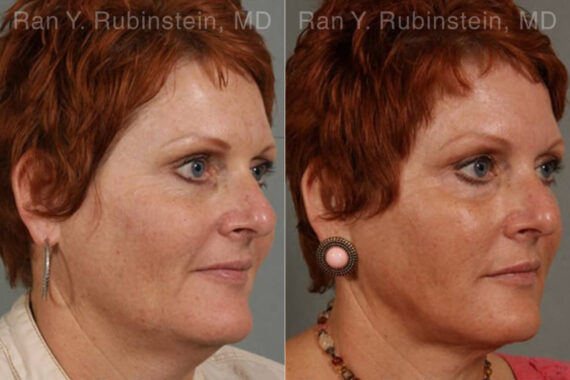 Laser Treatments Before and After Photos in Montvale, NJ, Patient 12823