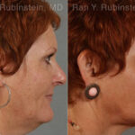 Laser Treatments Before and After Photos in Montvale, NJ, Patient 12823