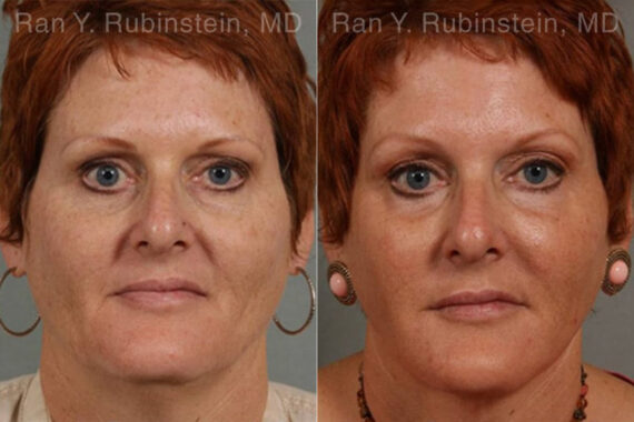 Laser Treatments Before and After Photos in Montvale, NJ, Patient 12823