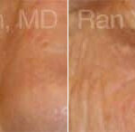 Laser Treatments Before and After Photos in Montvale, NJ, Patient 12836