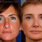 Revision Rhinoplasty Before and After Photos in Montvale, NJ, Patient 12982