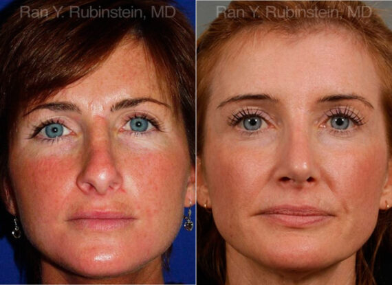 Revision Rhinoplasty Before and After Photos in Montvale, NJ, Patient 12982