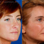 Revision Rhinoplasty Before and After Photos in Montvale, NJ, Patient 12982