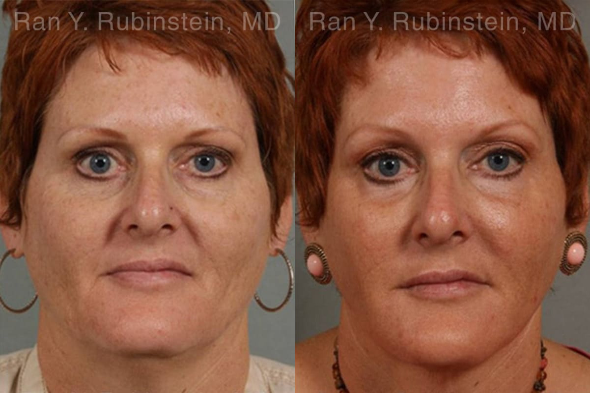 Laser Lift Precision Tx Before and After Photos in Montvale, NJ, Patient 13253