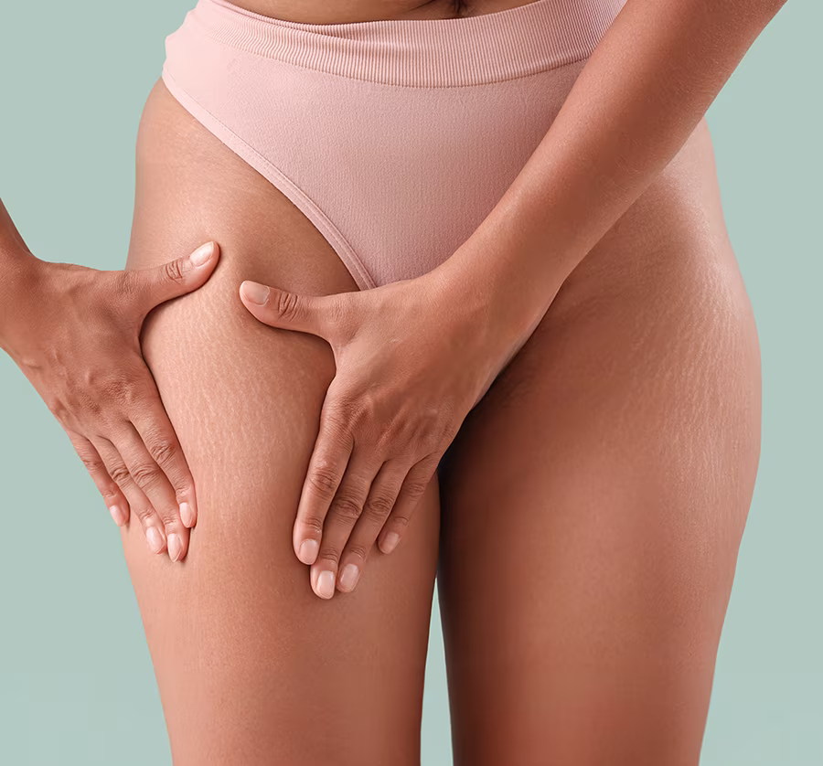 Woman’s thigh showing cellulite dimpling caused by fat beneath the skin and downward-pulling connective bands.