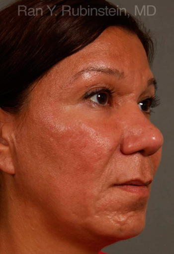 Ethnic Rhinoplasty - Obl Right - After