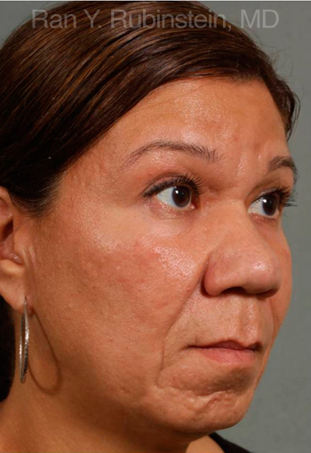 Ethnic Rhinoplasty - Obl Right - Before